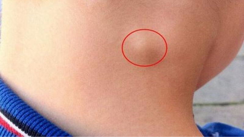 Khi xuất hiện sưng hạch bạch huyết nên đến các cơ sở y tế để được thăm khám