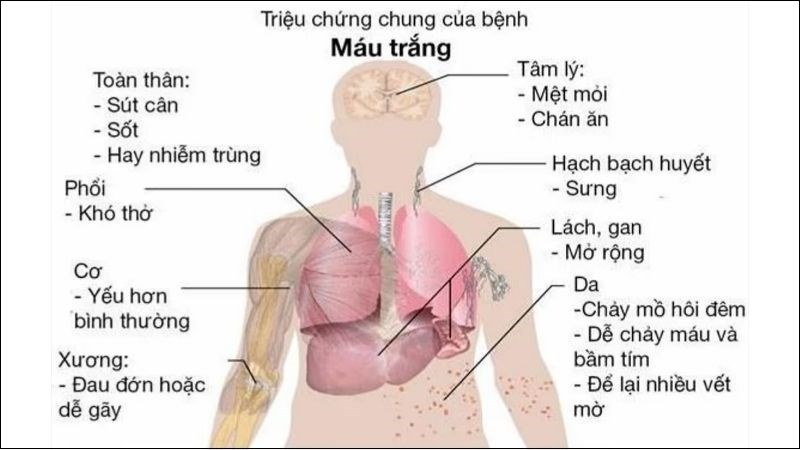 Bệnh máu trắng có thể gây ra viêm hạch bạch huyết