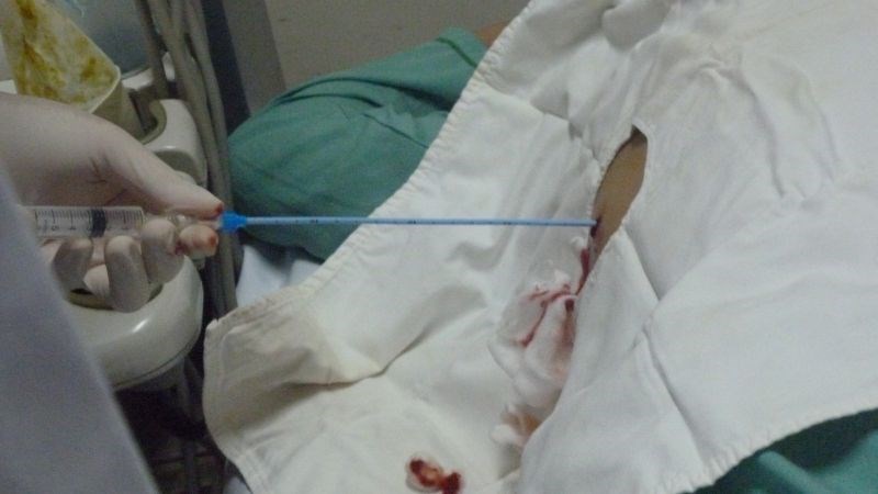 Có thể dẫn lưu áp xe để điều trị viêm hạch bạch huyết