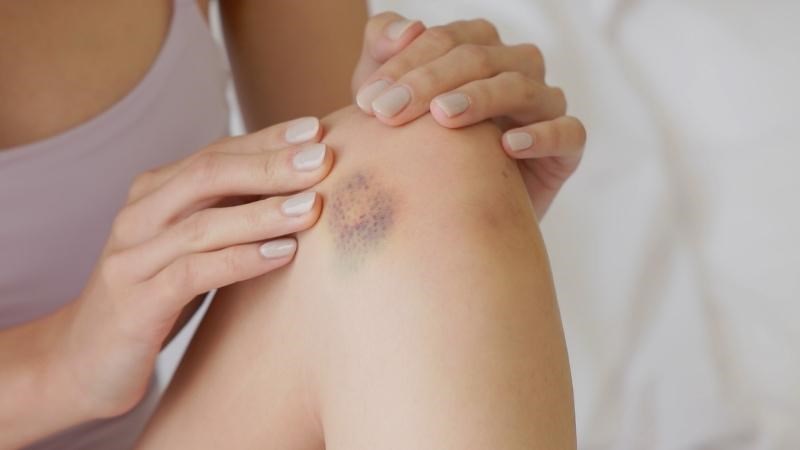 Bạn nên gặp bác sĩ nếu thường xuyên bị bầm tím không rõ nguyên nhân