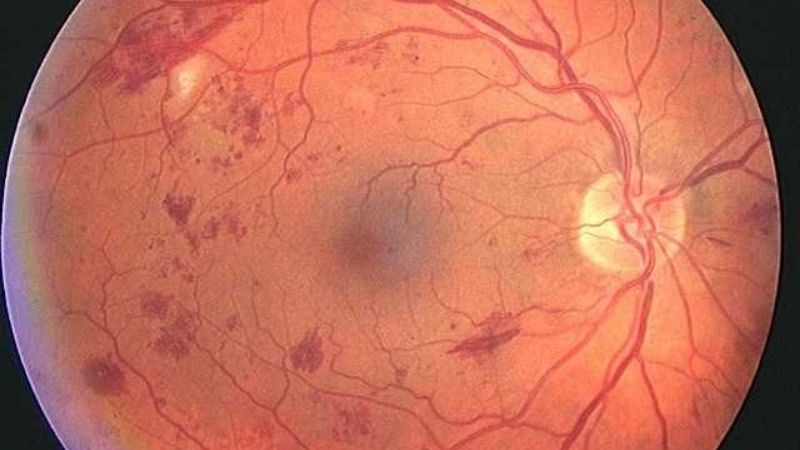 Bệnh võng mạc đái tháo đường có thể gây nên nhìn mờ