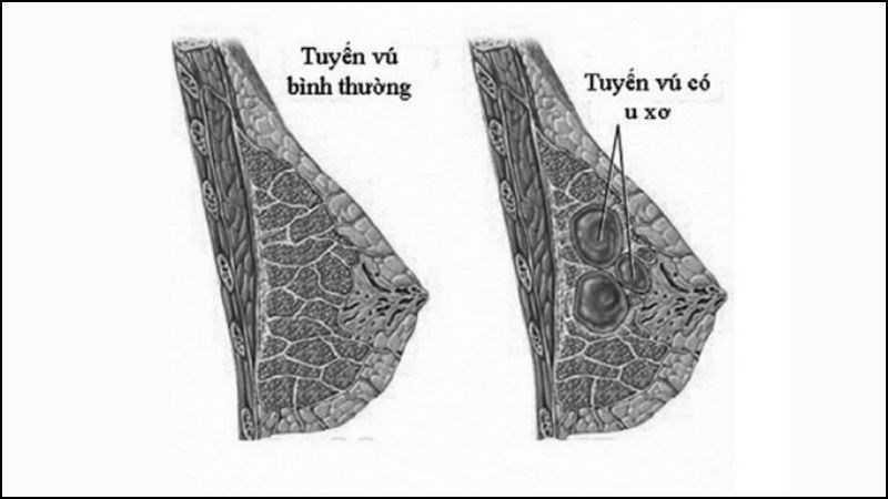 U xơ tuyến đơn giản là phổ biến nhất