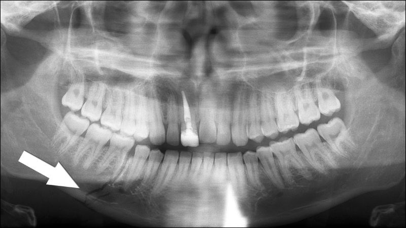 X-quang là phương tiện chẩn đoán gãy xương hàm hiệu quả, nhanh chóng