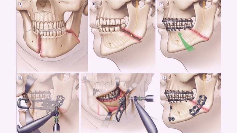 4. Chẩn đoán và điều trị gãy xương hàm