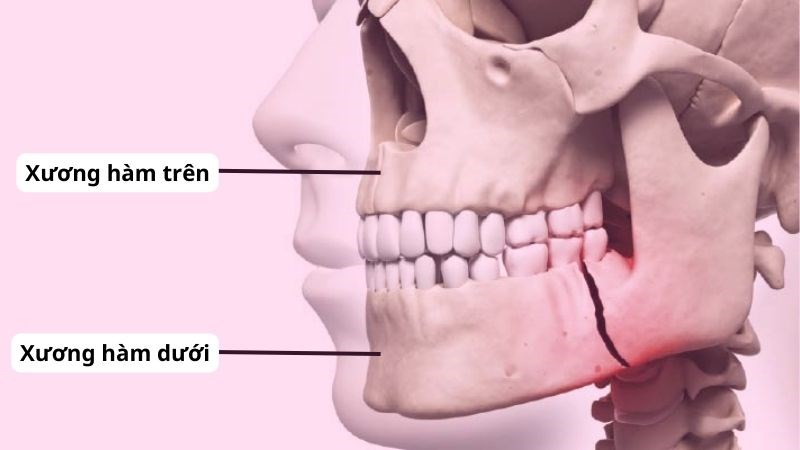 Phương pháp điều trị gãy quai hàm