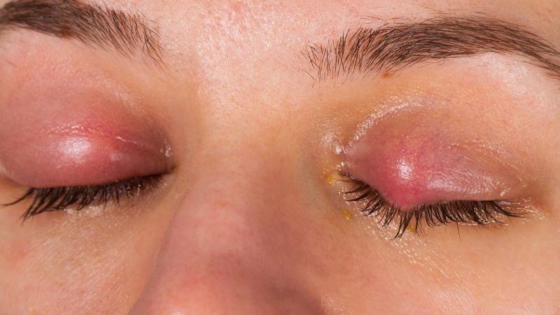 Bệnh chagas có thể làm người bệnh sưng mí mắt