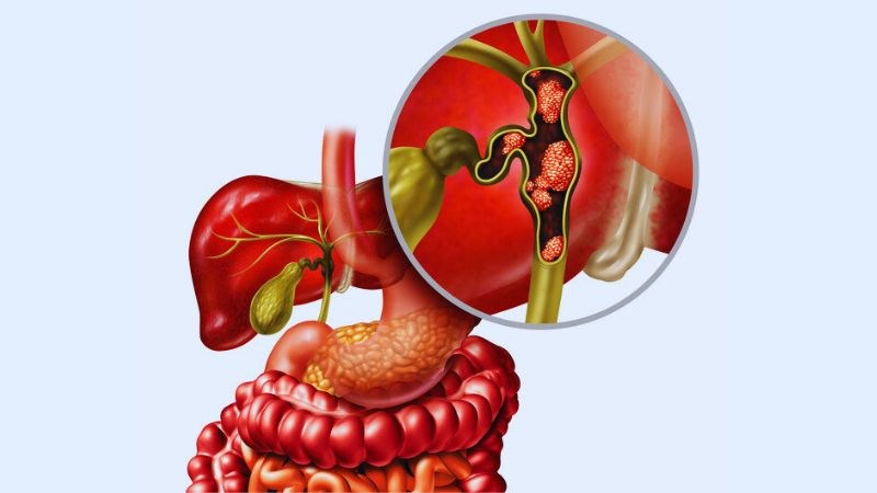 Sỏi ống mật chủ là sỏi mật có mặt ở đường mật chính ngoài gan