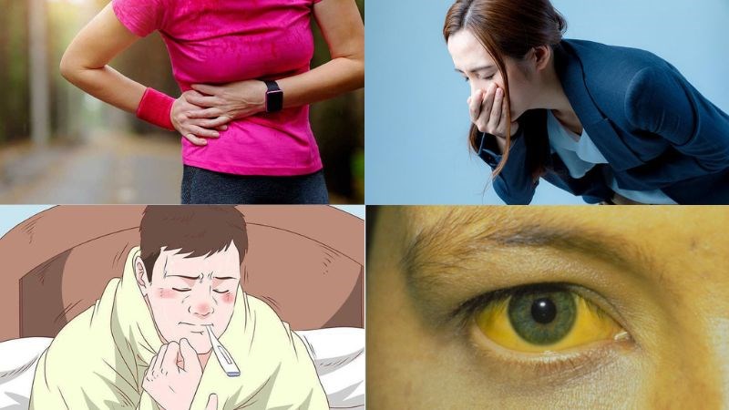 Sỏi ống mật chủ làm tắc nghẽn đường mật gây biểu hiện triệu chứng lâm sàng