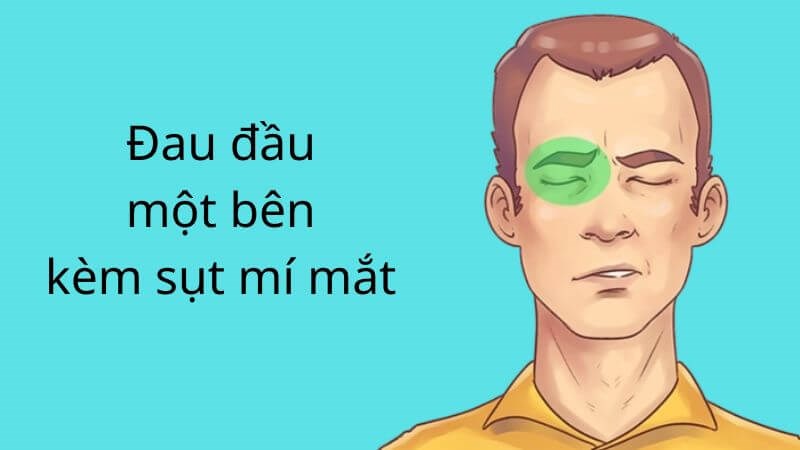 Triệu chứng xuất hiện là đau đầu một bên kèm sụt mí mắt