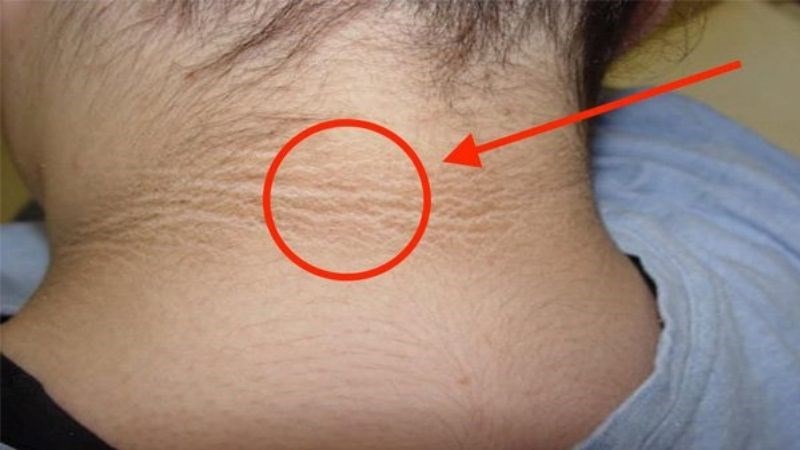 Những người xuất hiện gai đen hay mắc rối loạn chuyển hóa
