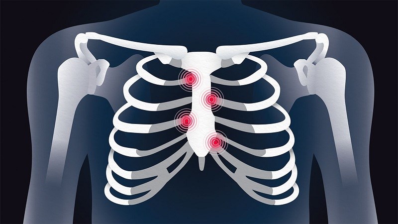 7. Những Điều Cần Lưu Ý Khi Bị Viêm Sụn Sườn