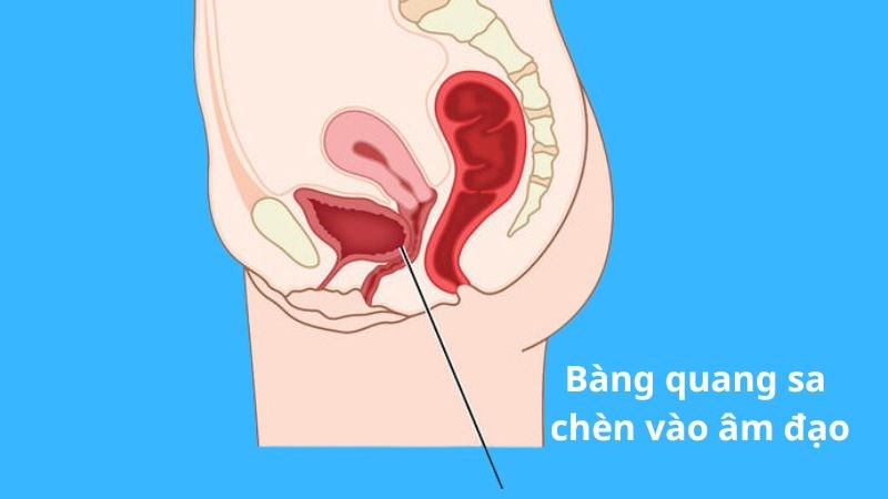 Sa bàng quang là tình trạng dây chằng giữ bàng quang bị suy yếu