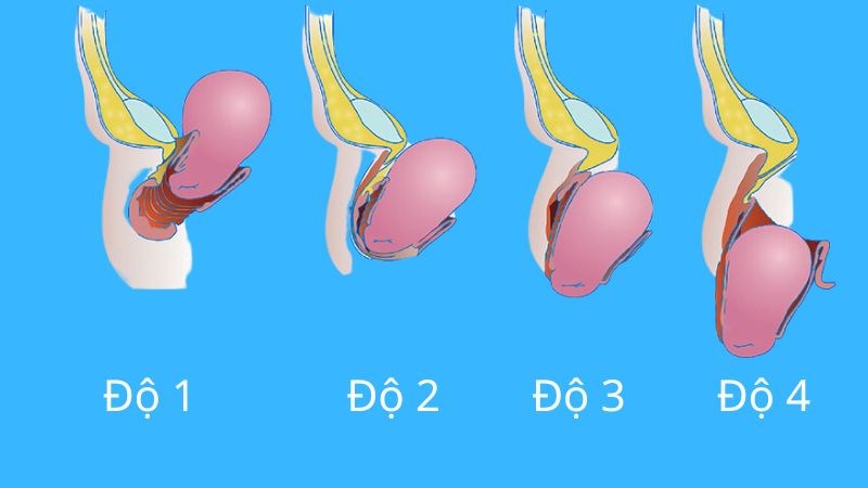 Bốn mức độ có thể gặp của sa bàng quang
