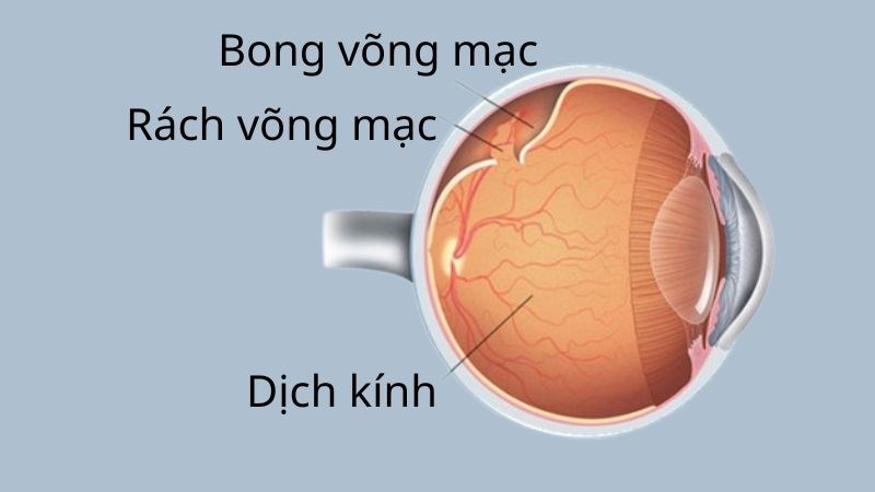 Bong võng mạc là tình trạng võng mạc rời khỏi vị trí ban đầu