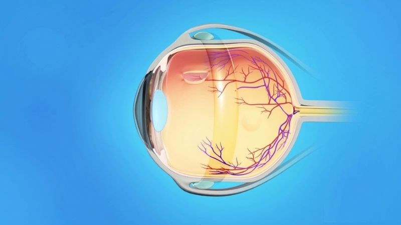 Ấn độn củng mạc để giảm áp lực lên thủy tinh thể