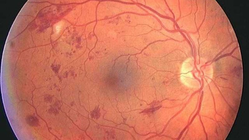 Đái tháo đường gây viêm và tổn thương võng mạc