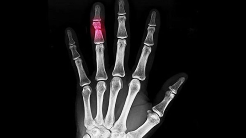 Trật khớp xảy ra khi xương ngón tay chệch khỏi vị trí bình thường Trật khớp xảy ra khi xương ngón tay chệch khỏi vị trí bình thường