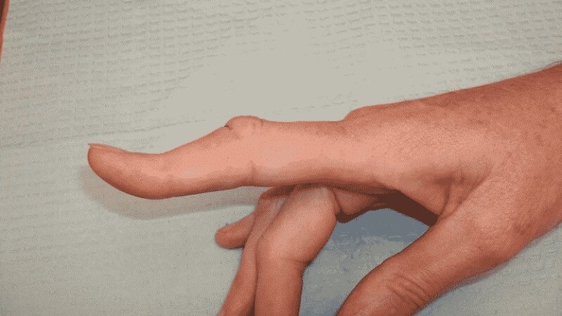 Khớp ngón tay biến dạng là dấu hiệu trật khớp