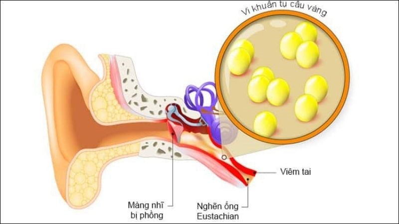Viêm mê nhĩ gây nên tình trạng rối loạn hoạt động cơ quan thăng bằng của cơ thể