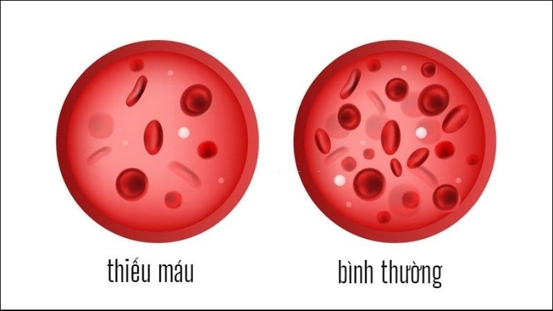 Thiếu máu làm giảm oxy lên não bộ gây ra choáng váng