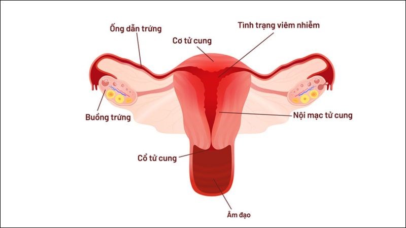 Viêm nội mạc tử cung là tình trạng viêm lớp trong cùng của tử cung