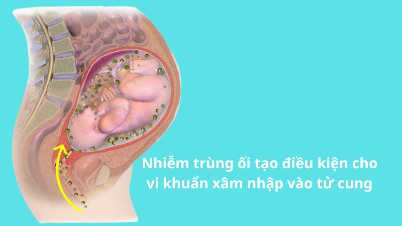 Nhiễm trùng ối là một yếu tố tăng nguy cơ mắc viêm nội mạc tử cung