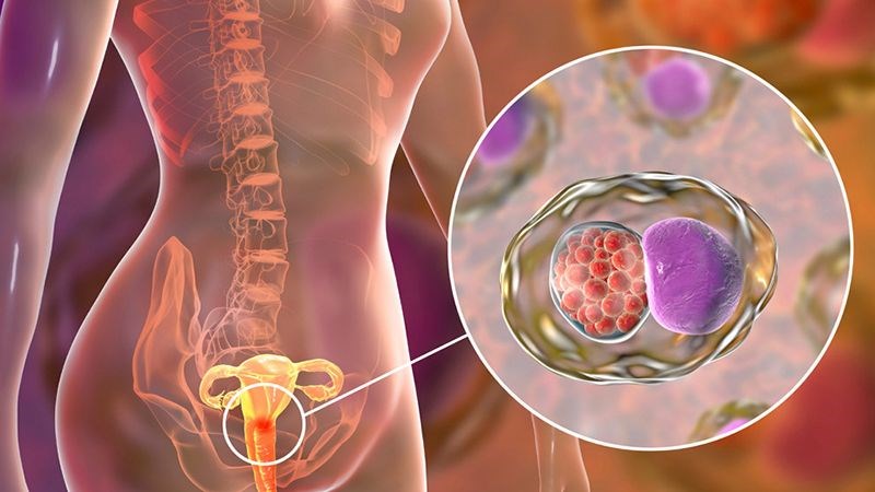 Vi khuẩn lây nhiễm qua đường tình dục là nguyên nhân chủ yếu gây viêm nội mạc tử cung
