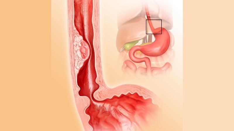 Khối u gây hẹp thực quản có thể lành tính hoặc ác tính