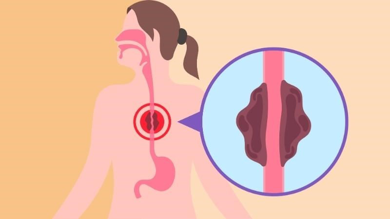 Hẹp thực quản là tình trạng lòng ống thực quản bị thu hẹp