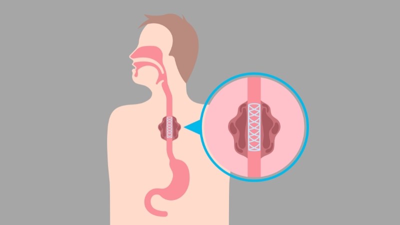 Đặt stent thực quản có thể di lệch và gây khó thở