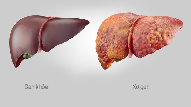 Xơ gan chiếm hơn 80% trường hợp giãn tĩnh mạch thực quản