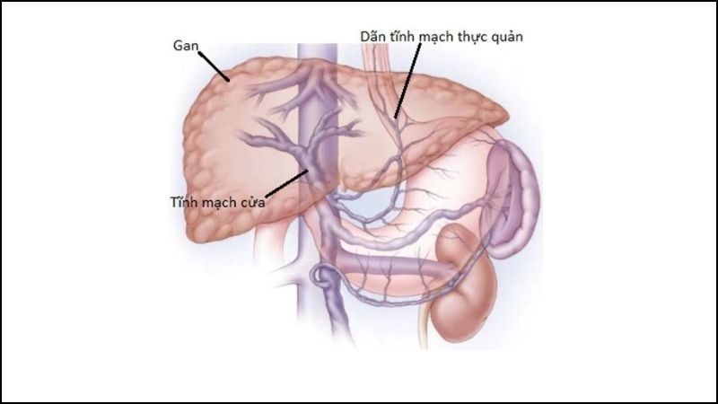 Giãn tĩnh mạch thực quản là sự phình ra của đoạn tĩnh mạch dưới niêm mạc vùng thực quản