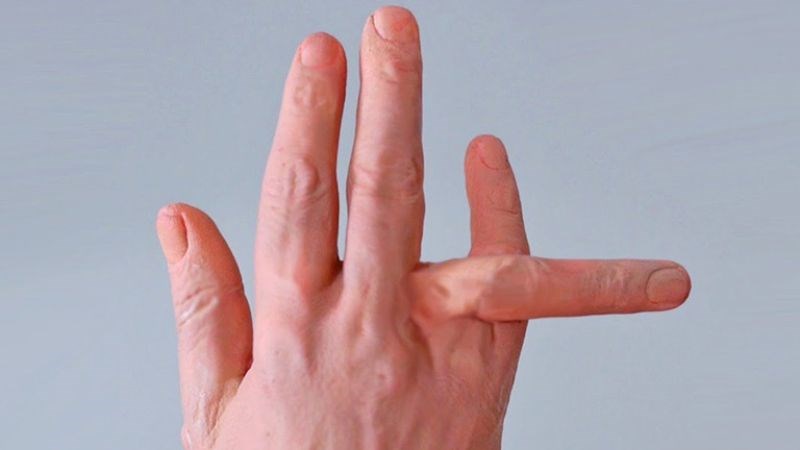 Bàn tay biến dạng sau gãy xương ngón tay Bàn tay biến dạng sau gãy xương ngón tay