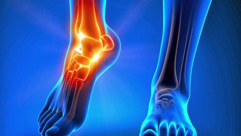 Những trường hợp gãy xương bị bỏ sót có thể tiến triển thành viêm khớp tái diễn