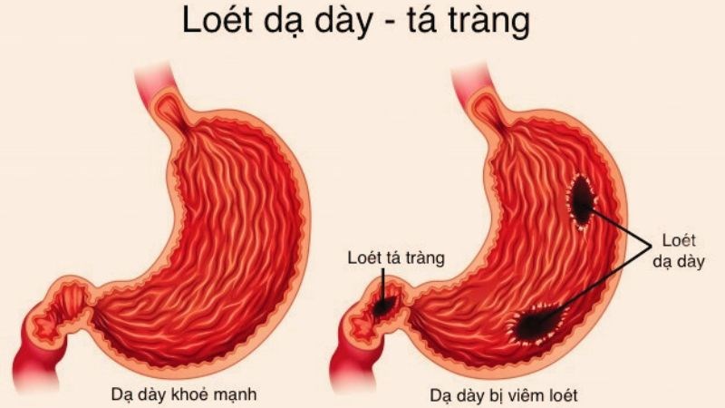 Loét dạ dày là nguyên nhân gây thủng dạ dày hàng đầu