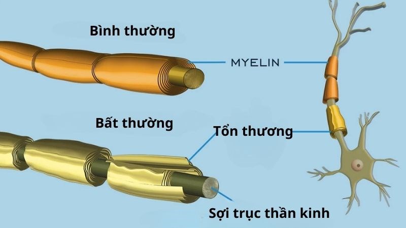 Hội chứng Guillain Barre là gì? Những điều cần biết về triệu chứng, nguyên nhân và điều trị