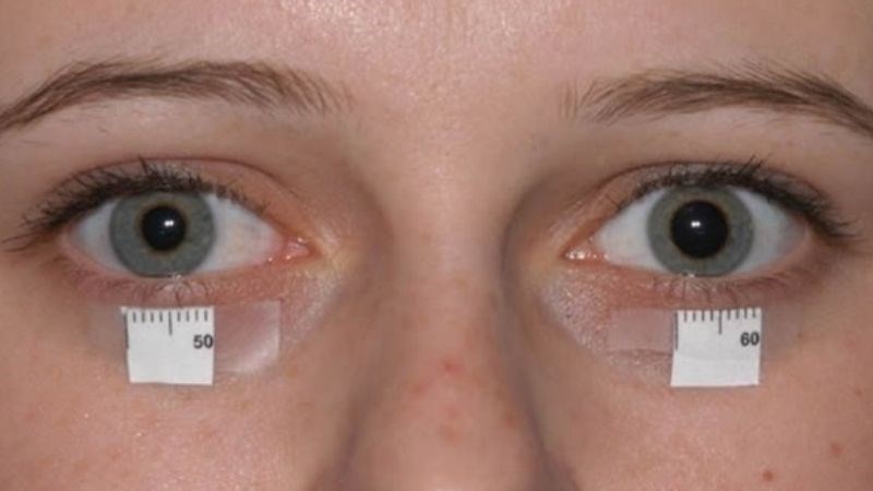 Bác sĩ sẽ khai thác bệnh sử cũng như qua việc đánh giá các triệu chứng hội chứng Horner Bác sĩ sẽ khai thác bệnh sử cũng như qua việc đánh giá các triệu chứng hội chứng Horner