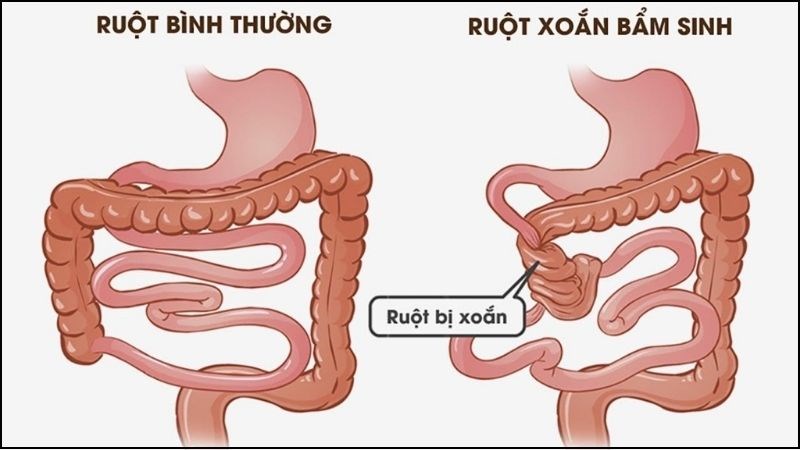 Xoắn Ruột: Nguyên Nhân, Triệu Chứng và Cách Điều Trị