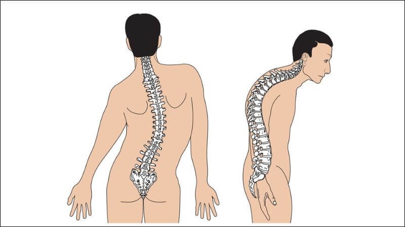 Khi cong vẹo cột sống nên đến các cơ sở y tế để được thăm khám