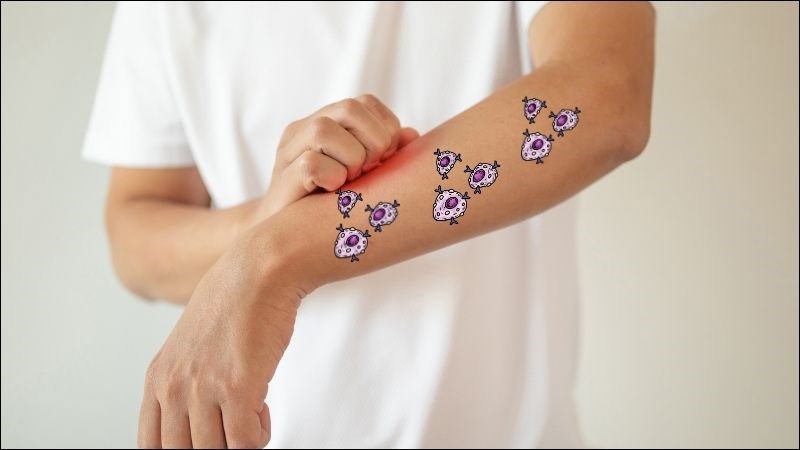 Bệnh tế bào mast là tình trạng rối loạn tăng sinh tế bào mast quá mức