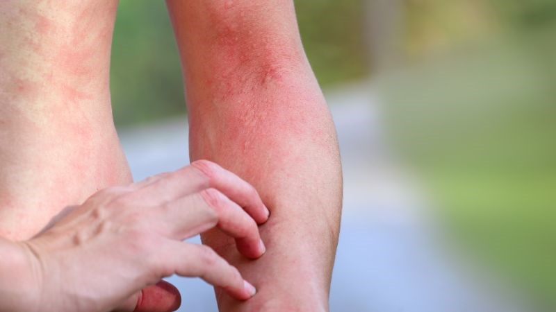 Các mảng da sưng, đỏ, ngứa là triệu chứng thường gặp của bệnh tế bào mast