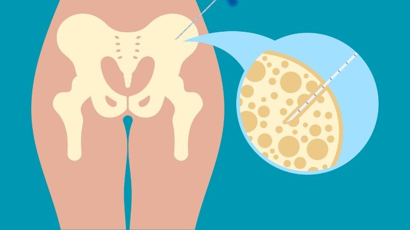 Sinh thiết tủy xương giúp kiểm tra mật độ tế bào mast