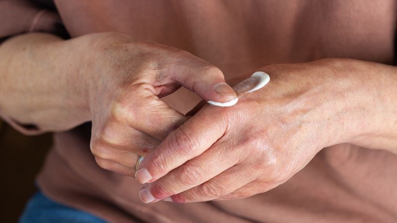 Bôi thuốc corticoid tại chỗ giúp giảm các triệu chứng ở da