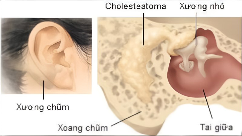 Viêm tai xương chũm là bệnh nhiễm trùng do vi khuẩn gây ra ở các tế bào khí xương chũm