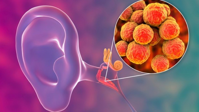 Nguyên nhân phổ biến gây viêm xương chũm là nhiễm trùng tai giữa không được điều trị