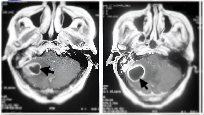 Áp xe tiểu não là một trong các biến chứng của viêm tai xương chũm