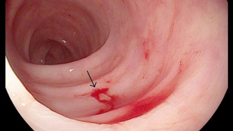 Hình ảnh nội soi chảy máu tiêu hóa