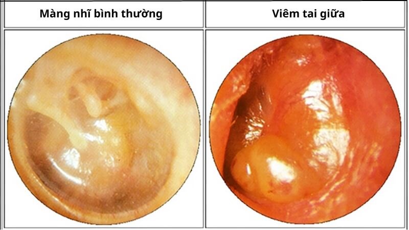 Viêm tai giữa là bệnh lý khá phổ biến dẫn đến đau tai