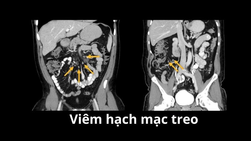 Chẩn đoán viêm hạch mạc treo qua xét nghiệm hình ảnh