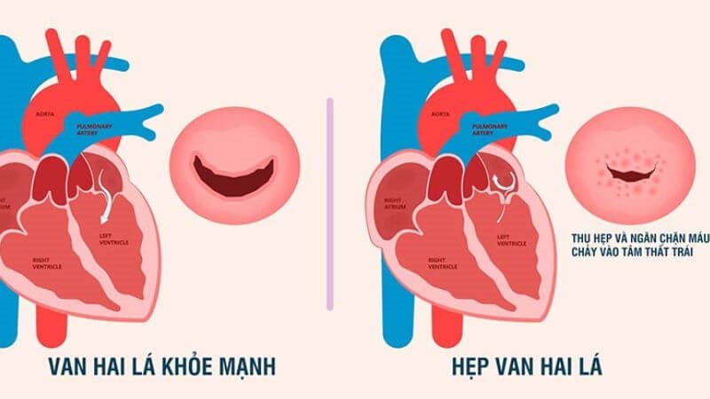 Hẹp van hai lá là tình trạng van hai lá tại tim mở không hết